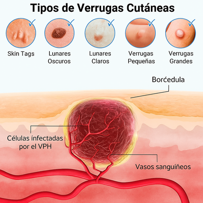 Spray Natural Anti-verrugas
